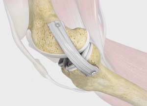 The mini-open medial collateral ligament repair with augmentation